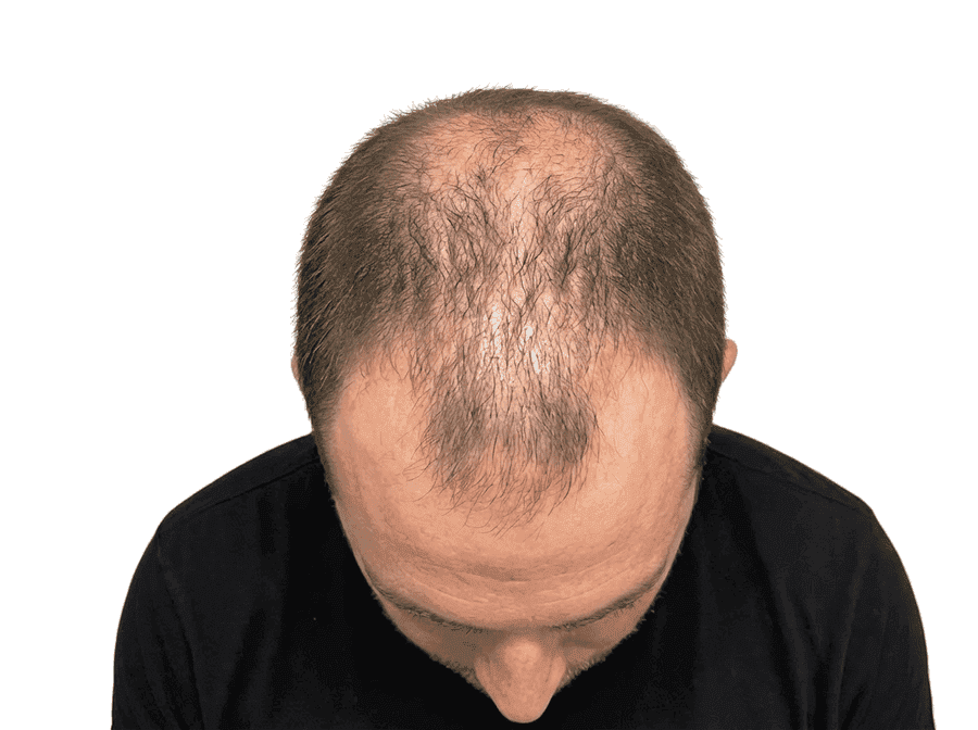 Hair shedding phase diagram